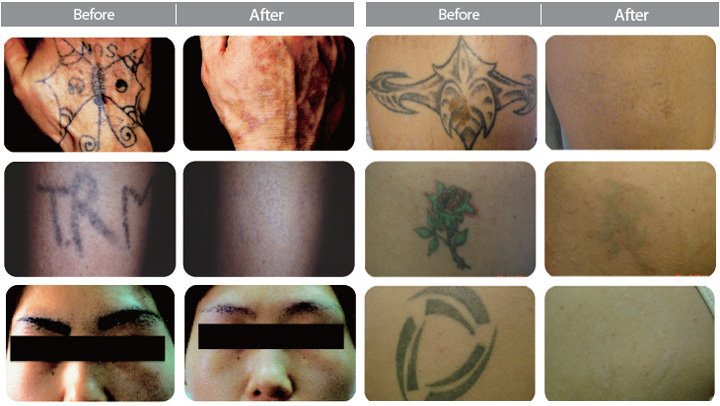 Online Saline Tattoo Removal